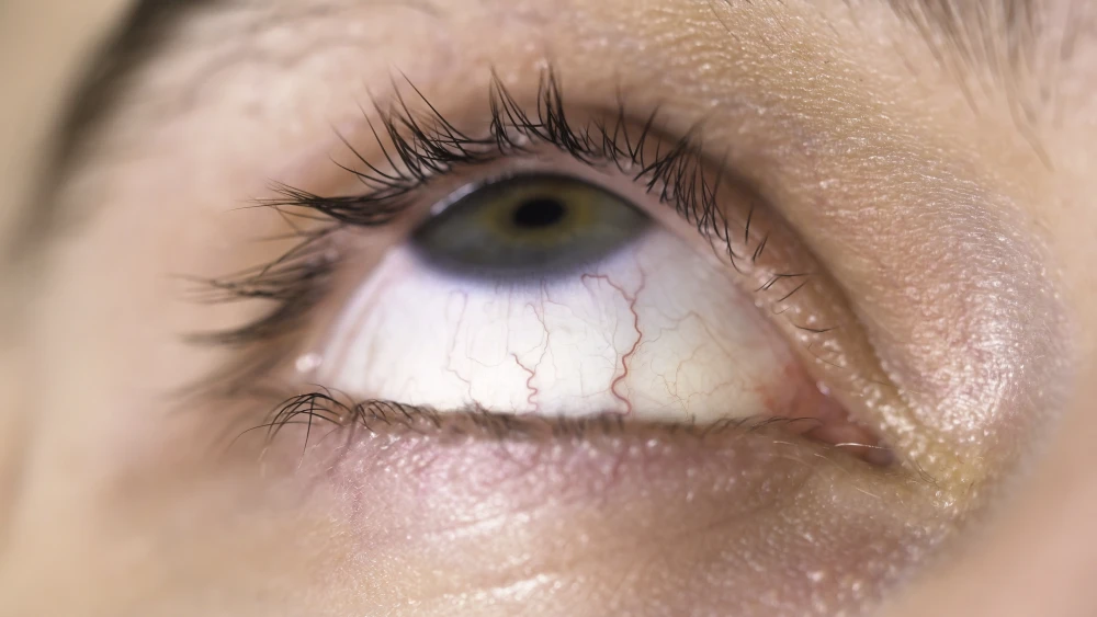 Ojo con enrojecimiento e irritación ocular, síntomas asociados al pterigión